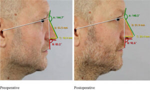 A Fresh Look at Nasal Tip Rhinoplasty: Insights and Essentials